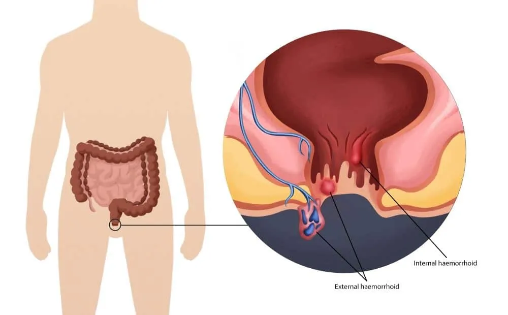 Bleeding During Stool (Rectal Bleeding): Causes, Tests & Best Treatment