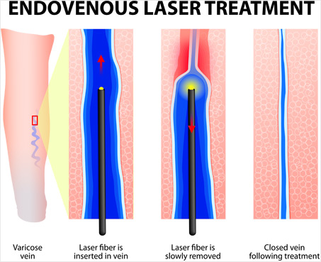 Endovenous Laser Treatment